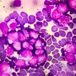 Kura Oncology: Commercialization In AML Presents Uneven Upside (NASDAQ:KURA)